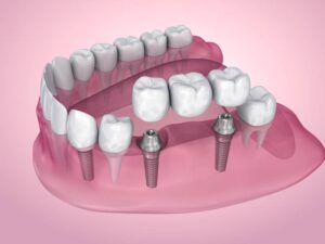 An illustration of a dental bridge attached to implants