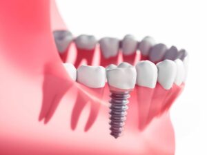 An illustration of a single tooth dental implant in San Francisco, CA