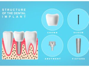 An illustration showing the structure of a dental implant placed by our dentist in San Francisco
